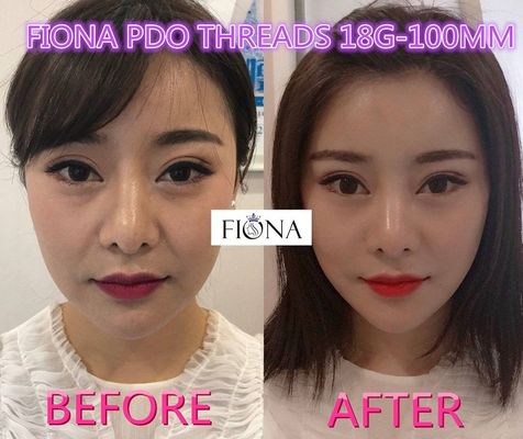 Fiona PDO и поток PCL, поток подтяжки лица PDO 38mm