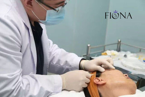 Не-хирургический Cannula подтяжки лица 360 4D 6D 12D w потока Cog подниматься стороны PDO PCL PLACL
