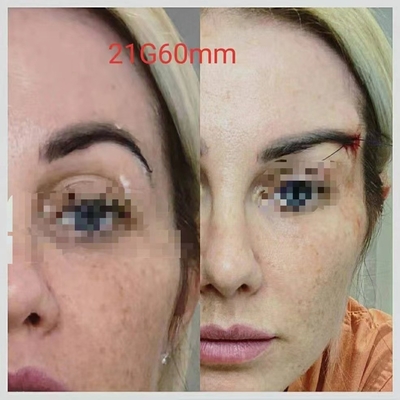 Cog PLACL PCL PDO продевает нитку/колючие потоки для Foxy Ponytail глаза поднимая 360 4D 6D 12D